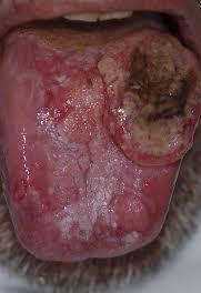 gejala kanker mulut