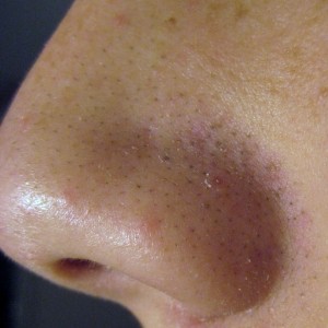 Tips untuk Menyingkirkan Komedo di Hidung secara alami