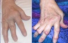 rheumatoid-arthritis
